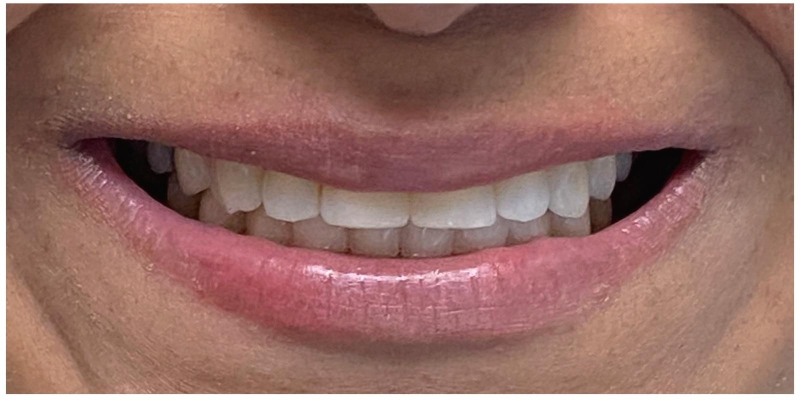 Aligned teeth after
